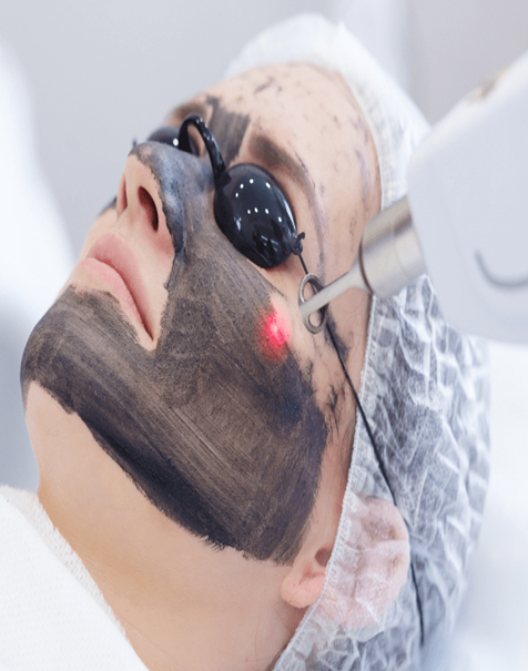 Carbon Peeling Treatment